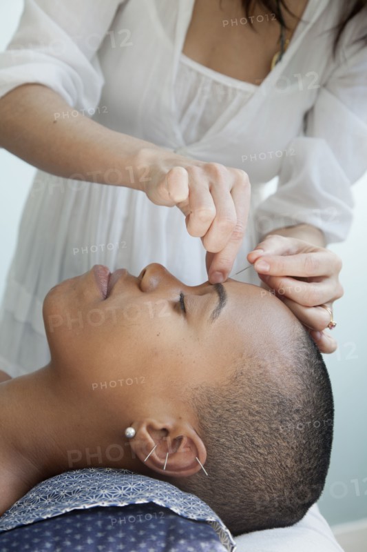 Black woman receiving acupuncture treatments
