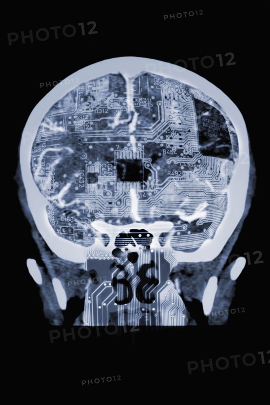 Circuit board in x-ray of skull