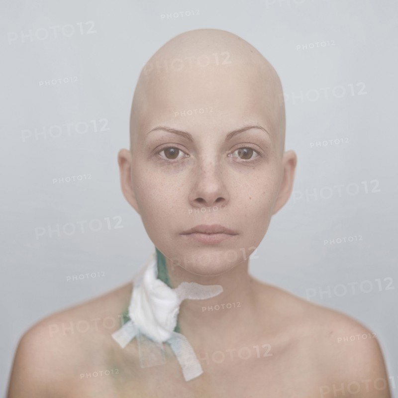 Bald Caucasian cancer patient with bandage on neck