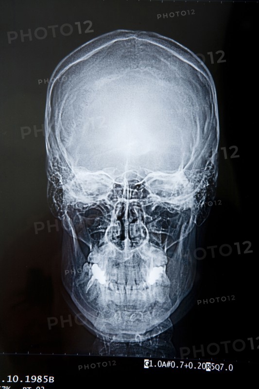 Close up of x-ray of skull
