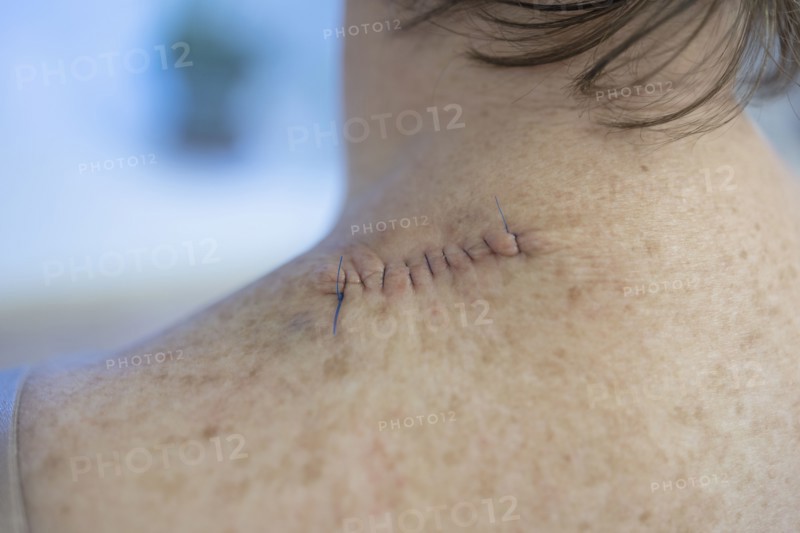 Medical stitches in woman's back after surgery