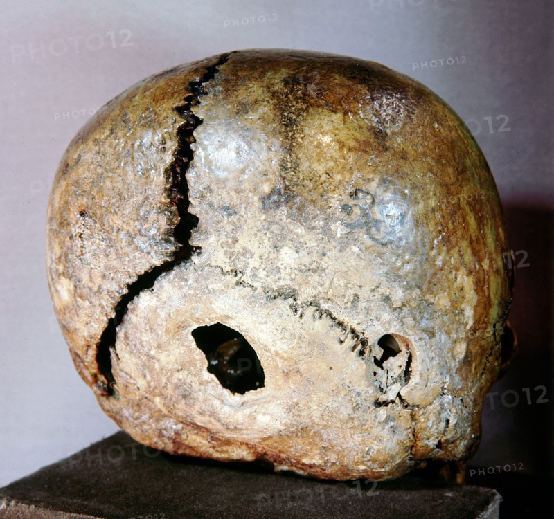 A trepanned skull