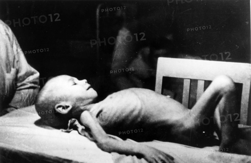 A dystrophic child examined in the leningrad pediatrics institute during world war ll.