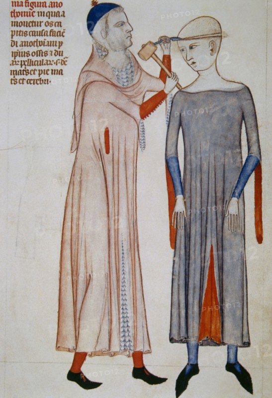 Trepanation. Miniature. 14th c. Treatise on anatomy by Mondino de Liuzzi (1270-1326).