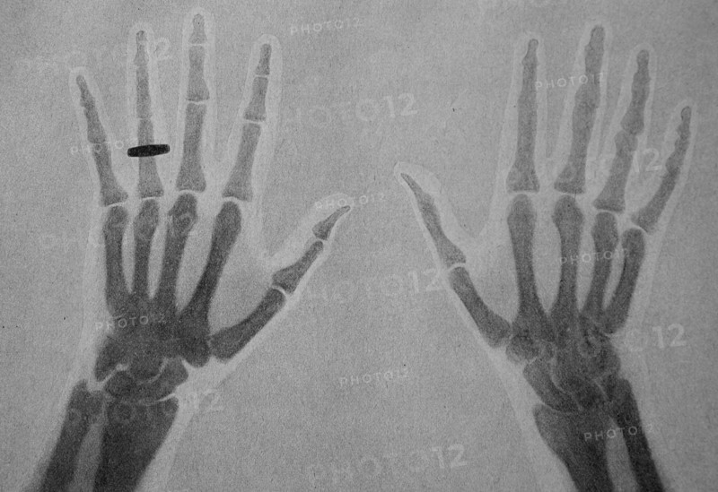 one of the first X-ray images of a human hand with ring