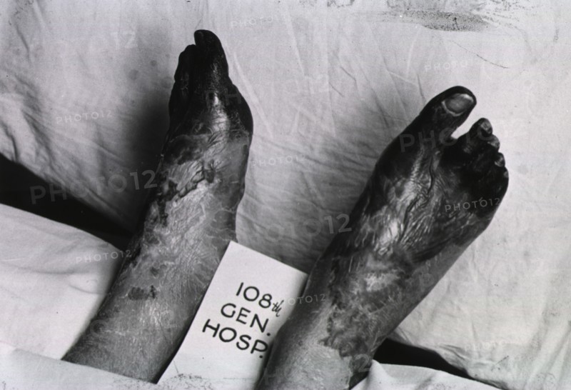Photograph of two cadaverous feet