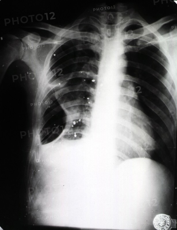 Ray showing chest wound
