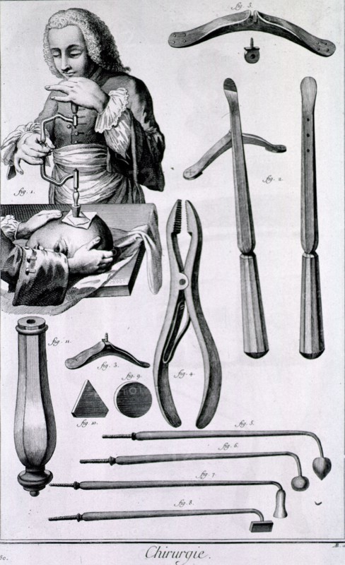 Concernant le tre´pan ca. 1700s