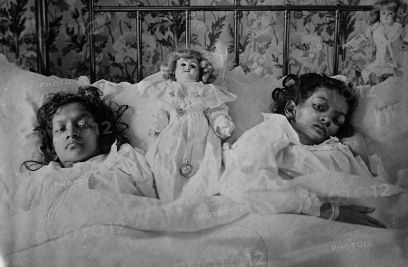 Radica & Doodica, Joint Hindoo twins after operation ca. 1902