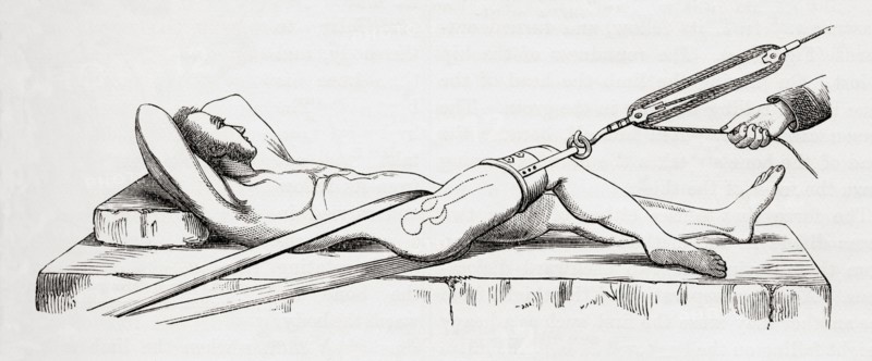 Reduction of dislocated thigh using pulleys.