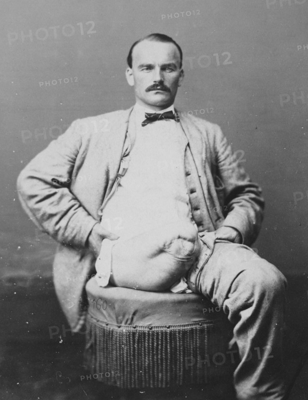 War-wounded Private Charles Myer, amputation of the right thigh, from the Photographic Catalogue of the Department of Surgery, 1880, photograph by William Bell, Historic, digitally restored reproduction from an original of the period.