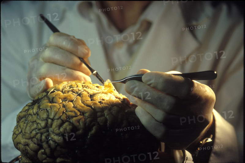 Dissection of a human brain, brain research, 2004