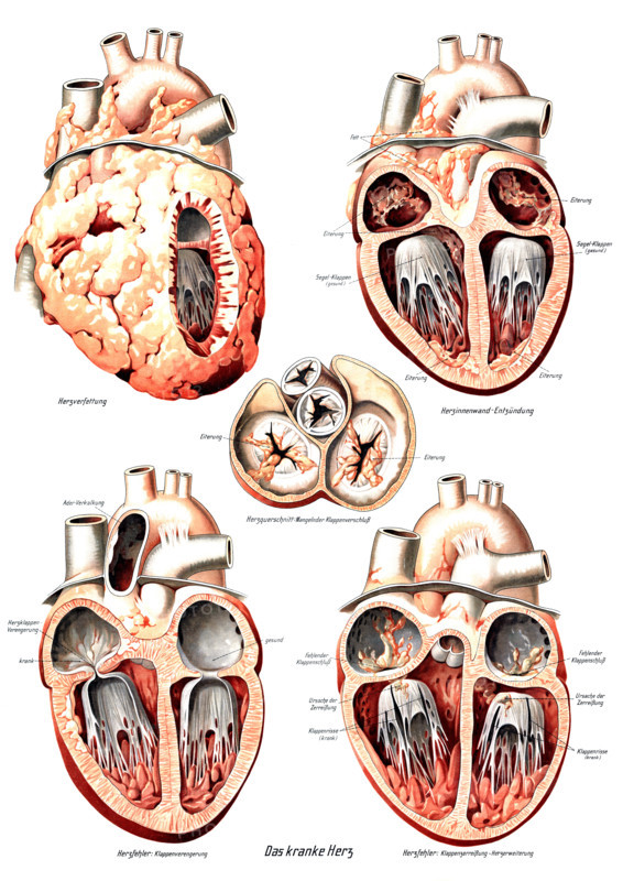 Anatomy, human, various pathological changes of the human heart, fatty degeneration of the heart, endocarditis, cross-section of the heart and valve defects, heart defects such as valve stenosis, valve rupture and cardiac dilation, reproduction of a historical school picture, mural or teaching chart, authentic, date unknown.