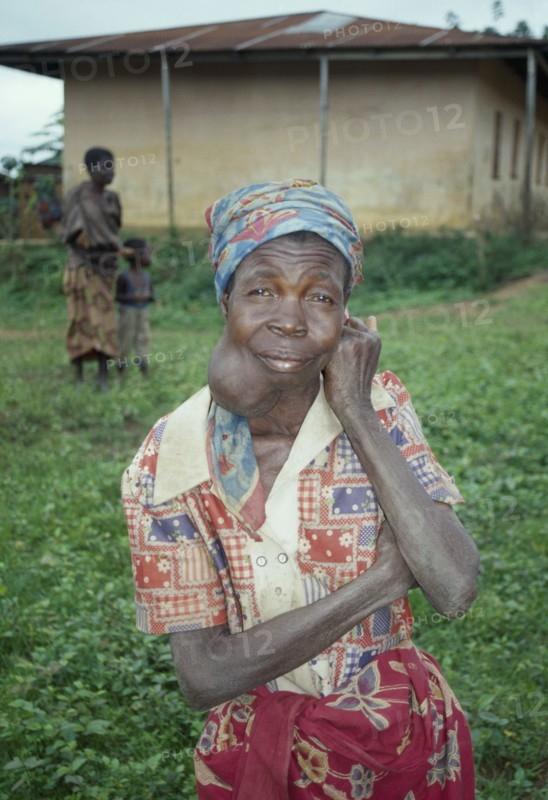 ANGOLA, Health, Woman suffering from goitre iodine deficiency