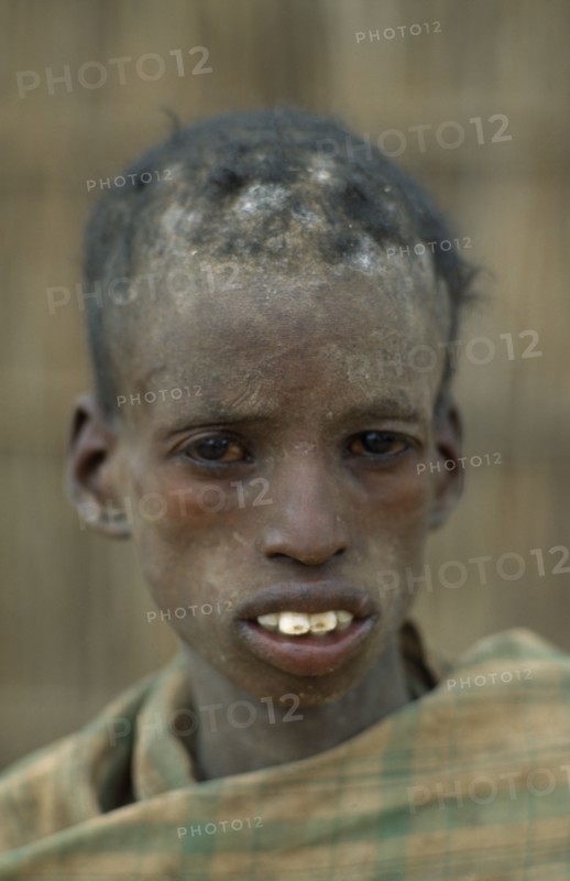 SOMALIA, Baidoa, Severely malnourished boy at CONCERN feeding centre.