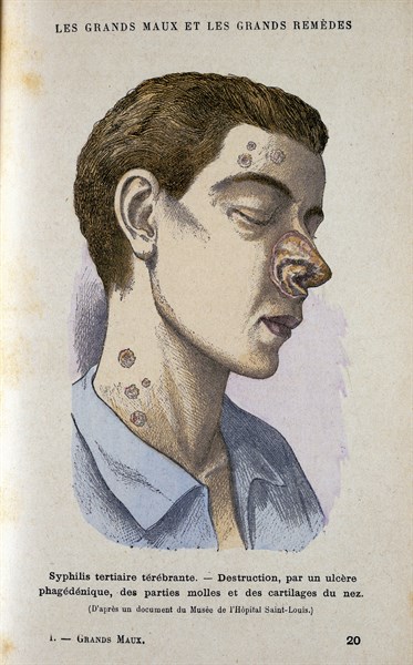 Man suffering from tertiary Syphilis