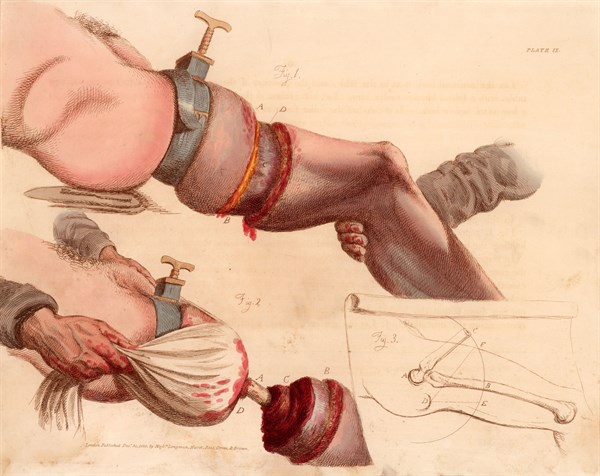 Amputation of the leg at the thigh