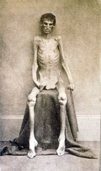 A Federal prisoner, returned from prison American Civil War c 1865
