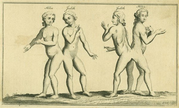 Siamese or conjoined twins