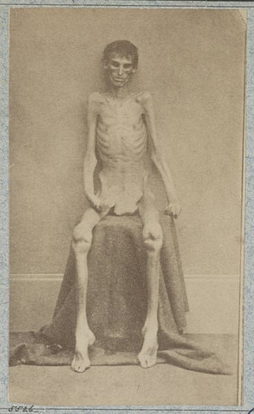 Returned Federal prisoner from Andersonville prison, 1864