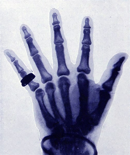 X-Ray halftone presentation of a full hand with ring