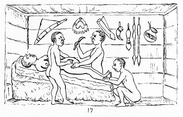 Line drawing of a Cesarean