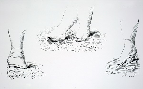 Damaged feet caused by foot binding in China