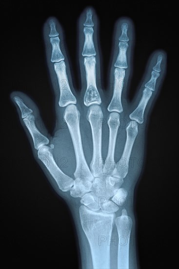 Hand X-ray of an adult female