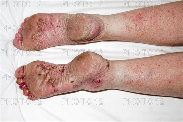 Patient with Atopic dermatitis or endogenous eczema