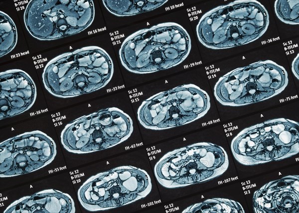 MRI scan