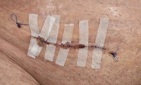 Stitched wound suture with filaments and Steristrips after hernia surgery