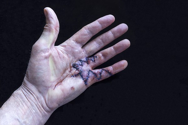 Fresh surgical sutures of a Duypuytren's contracture on the small and ring finger of the left hand