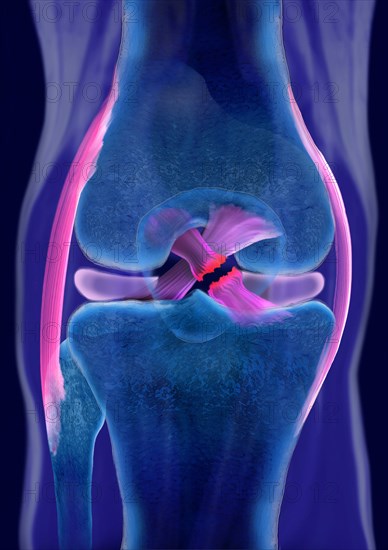 Rupture of a cruciate ligament