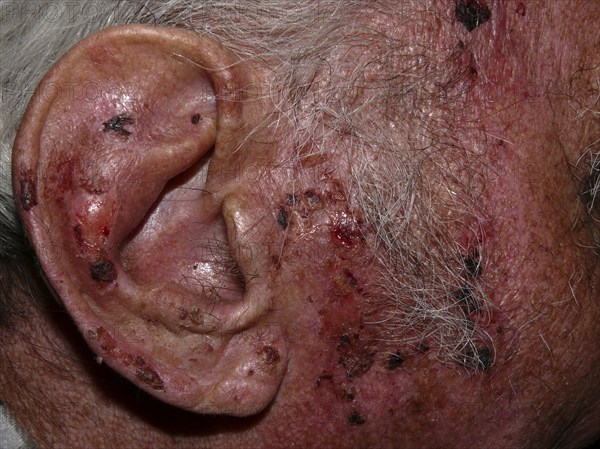 Squamous-cell carcinomas of the face and ear