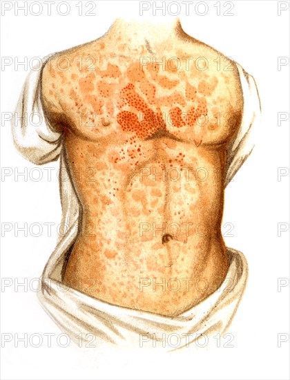 Measles