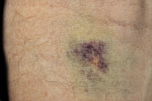 Haematoma after blood sampling