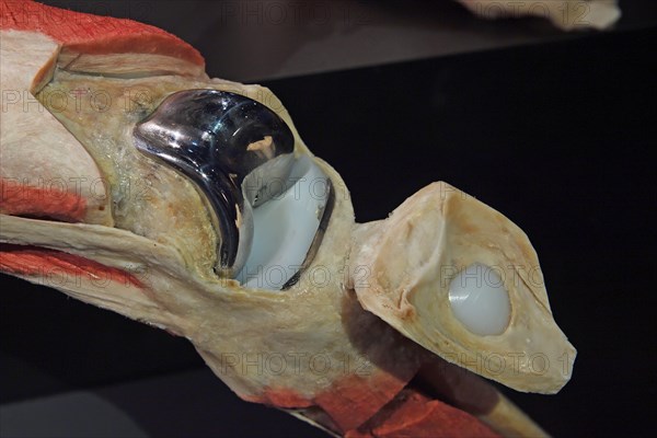 Artificial knee joint