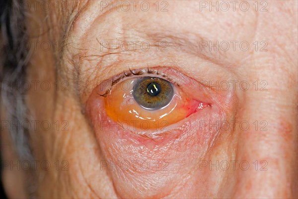 Infectious conjunctivitis