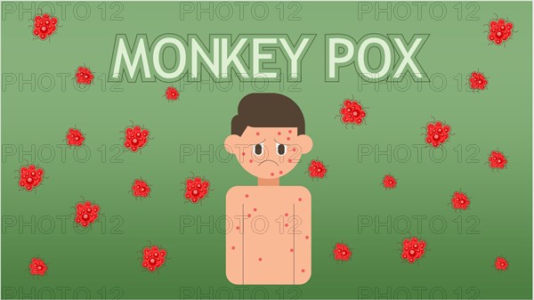Monkeypox concept