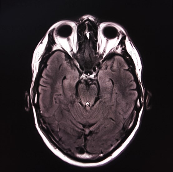 Black and white image of an MRI scan of a brain, showing detailed brain structure