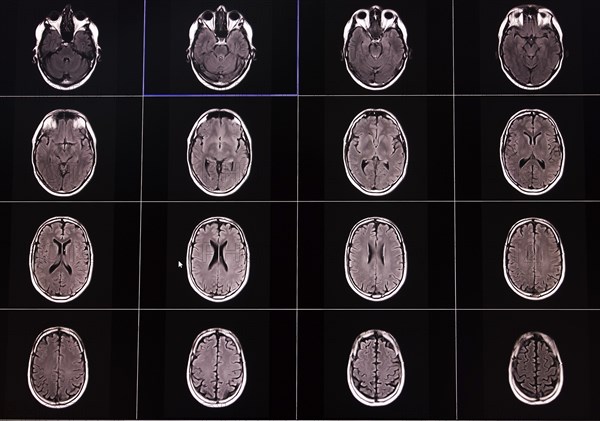 Several MRI scans of brain cross-sections shown in black and white on a black background