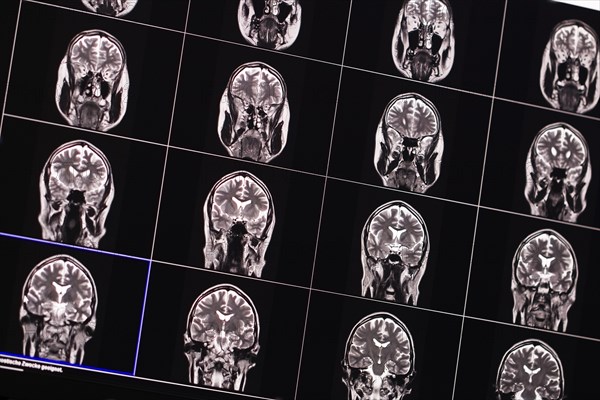 Several MRI images of a human brain in black and white, arranged in a grid view