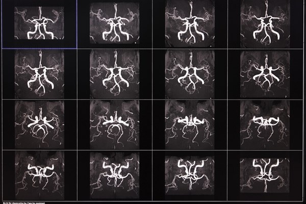 Several MRI images show the arteries of the brain in black and white with detailed neuronal