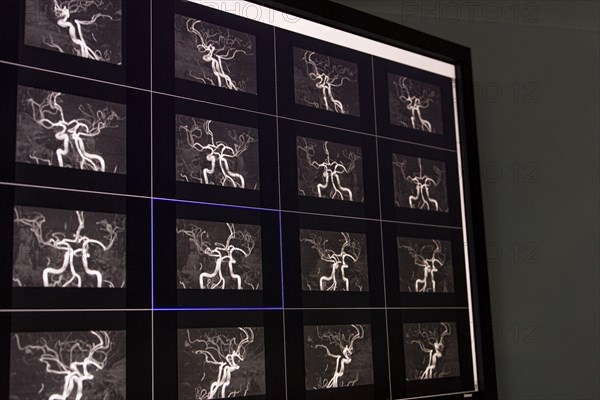 Several magnetic resonance imaging MRI cross-sectional images of the cerebral arteries and vessels