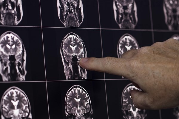 Finger points to a section of a brain MRI image