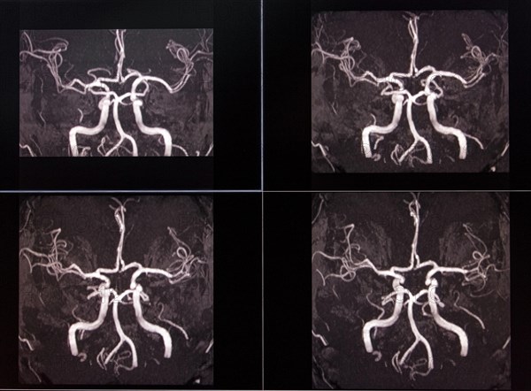 MRI X-ray image of brain arteries showing complex blood vessels in black and white