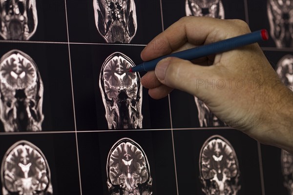 Hand with pen points to MRI images of human brains in black and white