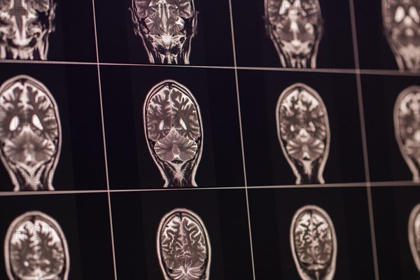Several human MRI brain scans arranged in black and white on a panel