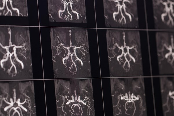 X-ray images of cerebral arteries and vessels of a human head, shown in black and white contrasts