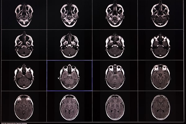 Black and white images of an MRI scan of the brain in several sectional planes